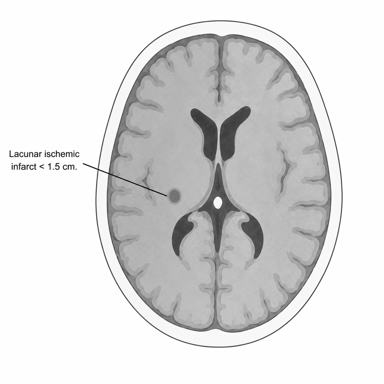 Schematic of minor infarct