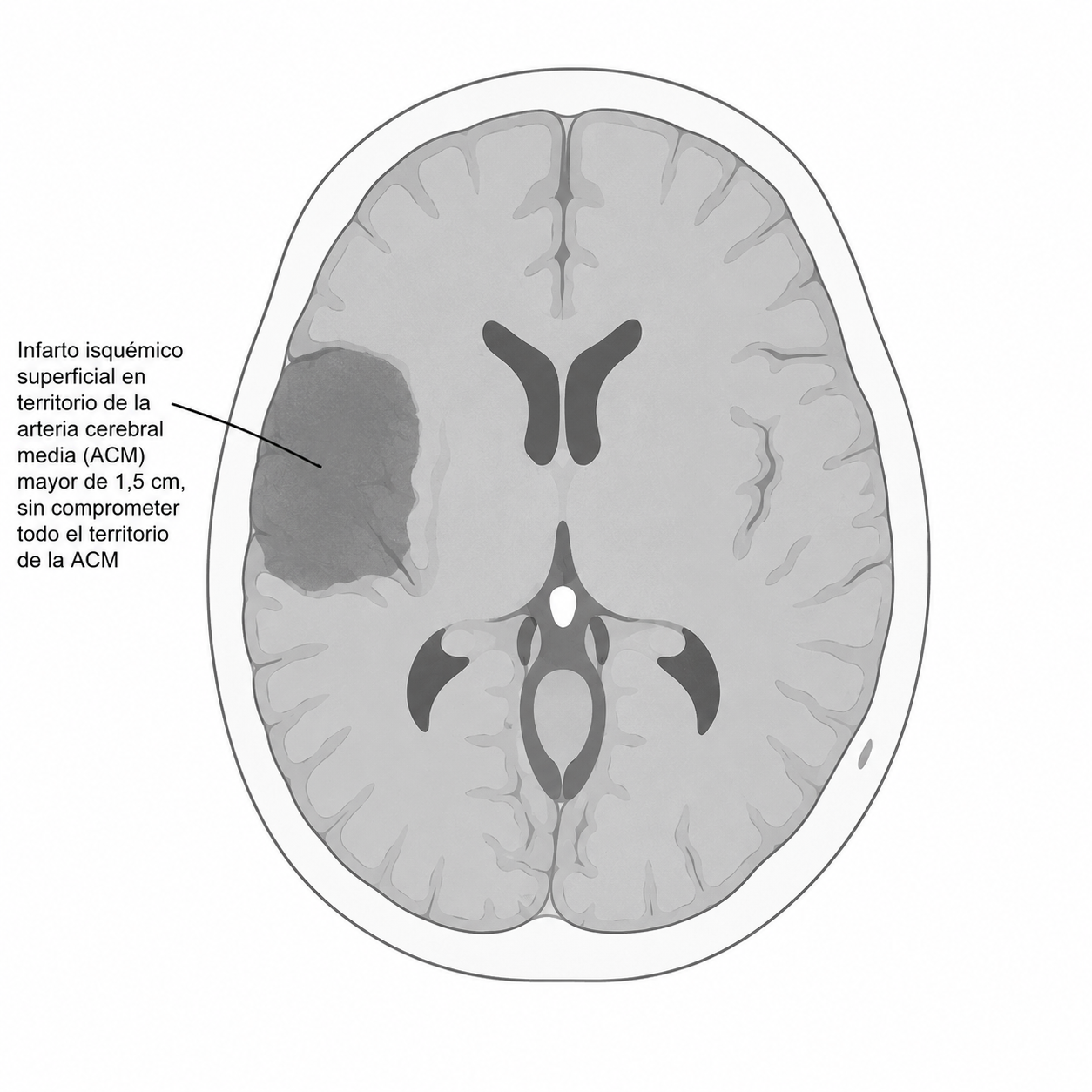 Schematic of moderate infarct