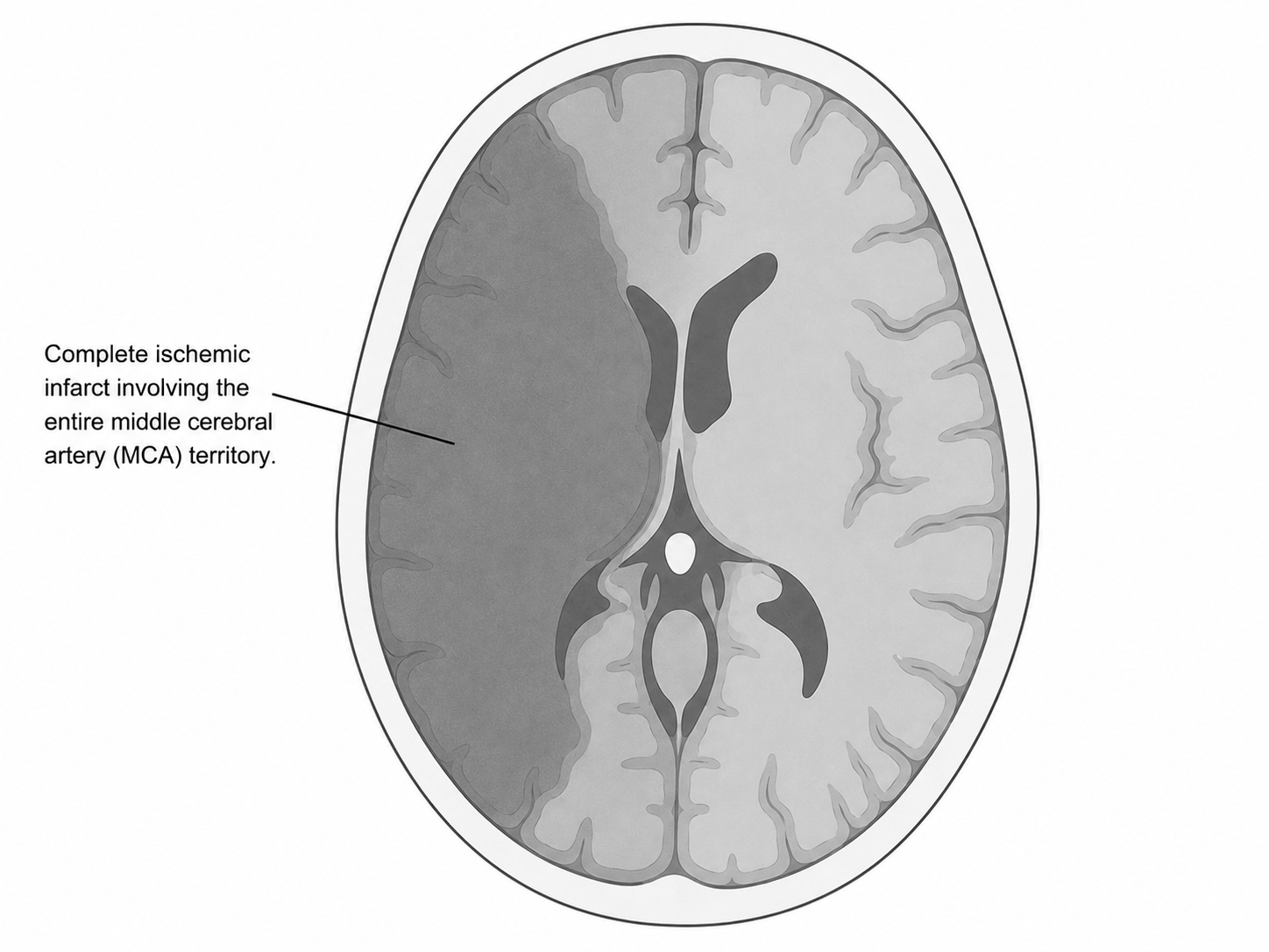 Schematic of major infarct 1
