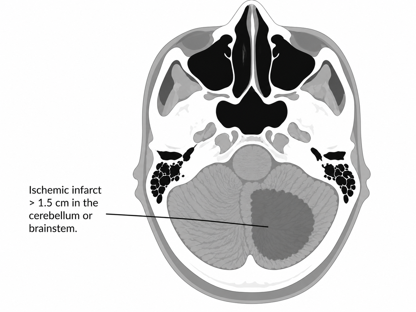 Schematic of major infarct 2